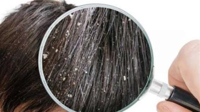 ما هي العلاقة بين قشرة الرأس وتساقط الشعر؟.. إليك الإجابة