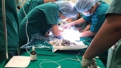 بعد عملية استمرت 12 ساعة.. فريق طبي ينجح في فصل توأم ملتصق