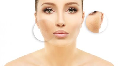 ماذا تعرفين عن «كلف الحمل»؟ وكيف يتم علاجه؟