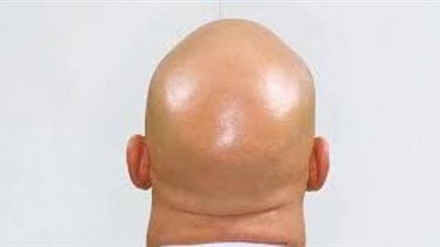 دراسة تفسر:  لماذا يصاب الرجل الأصلع أكثر  من غيره بمضاعفات ”كورونا”