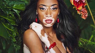 الجمال لا يعرف المرض.. معلومات عن أغرب عارضات الأزياء في العالم