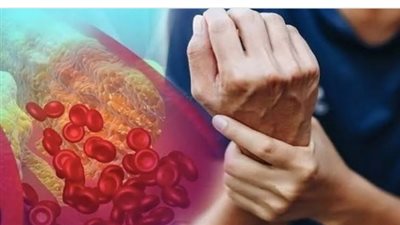 «تظهر في الساق».. هذه العلامات تدل على ارتفاع الكوليسترول