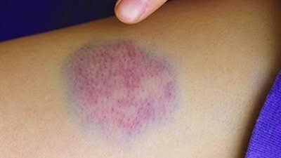 تسبب الفزع..تعرف علي لغز الكدمات الزرقاء التي تظهر فجأة بالجسم