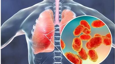 أبرزها عدوى الجهاز التنفسي.. معلومات لا تعرفها عن أخطر الأمراض في التاريخ