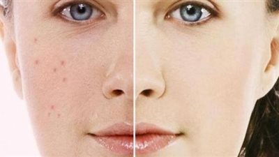 وصفة سحرية للقضاء علي البقع الداكنة وبثور الوجه