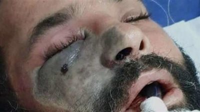 عاجل وخطير.. اكتشاف 10 حالات مصابين بالفطر الأسود