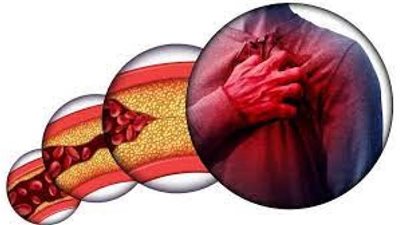 ما هي أعراض ارتفاع الكوليسترول؟