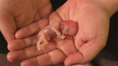 أستاذ شريعة يوضح حالة واحدة يجوز فيها الإجهاض