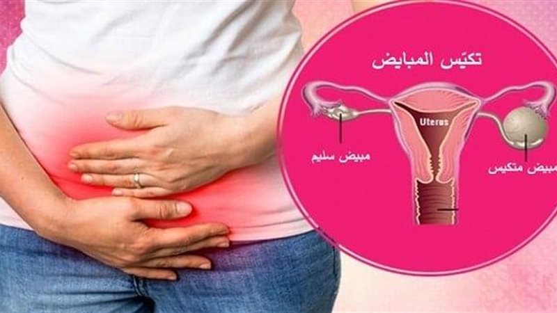 تكيس المبايض