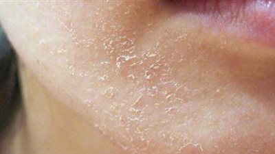 خلى بالك.. جفاف الجلد يسبب العديد من الأمراض