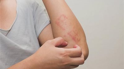 مش هتصدقي.. حل سحري وسريع للتخلص من «بثور حكة الجلد»