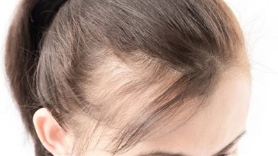 ما هى أسباب الصلع المبكر وطرق علاجه؟.. إليك الإجابة