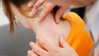 الصدفية .. ما هو هذا المرض وكيف يتم المعالجة منه؟