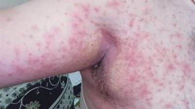 الفطر الأسود  .. الدكتور هاني الناظر يكشف أعراض المرض القاتل