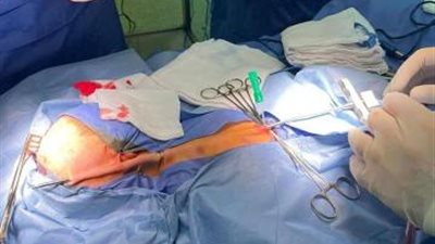 تعاون بين وزارتي الصحة والتعليم العالي لإنقاذ حياة طفل حديث الولادة