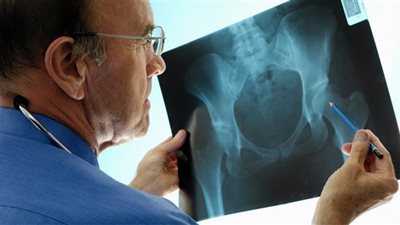 عادات خاطئة تزيد الإصابة بهشاشة العظام.. تعرفي عليها