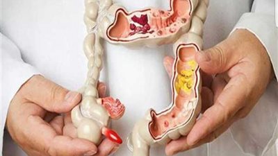 «سرطان القولون».. معلومات لا تعرفها عن هذا المرض الفتاك