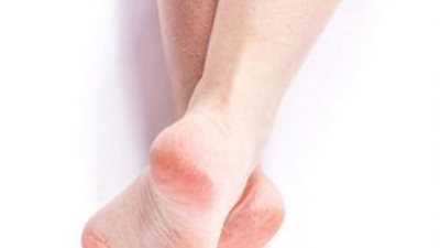 روشتة علاجية لن تتوقعيها لعلاج تشققات القدمين.. تعرفي عليها