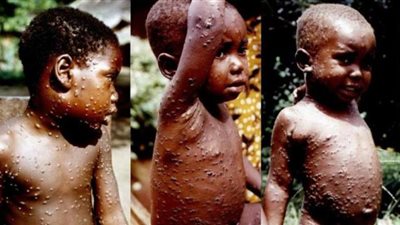 وسط التفشي المرعب.. معلومات صادمة عن مرض «جدري القرود»