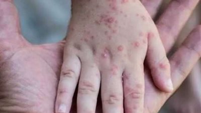 فرنسا تُسجل 16 إصابة جديدة بفيروس جدري القرود