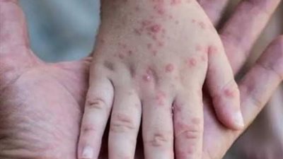 المغرب تعلن رصد أول إصابة بجدرى القرود لشخص قادم من أوروبا