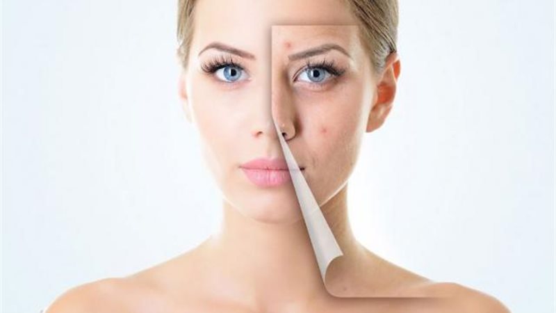 أقوى دواء لعلاج حب
