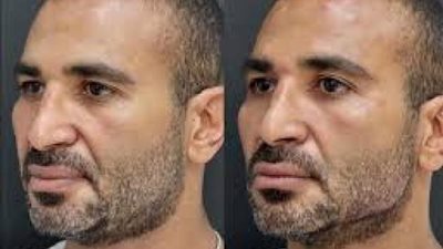 ”جمالهم مش رباني”.. آخرهم أحمد سعد.. نجوم خضعوا لعمليات تجميل
