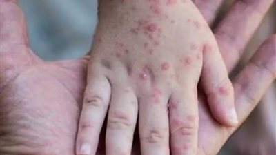 الصحة تكشف إجراءات التصدى لفيروس جدرى القرود