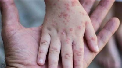 الصين تُسجل أول إصابة بـ جدري القرود