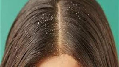 نصائح للحد من ظهور القشرة في فصل الشتاء