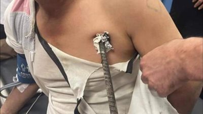 تفاصيل نجاح جراحة لاستخراج سيخ حديد اخترق صدر عامل بمستشفى قصر العيني