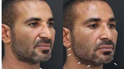 احمد سعد يجري عملية تجميل جديدة.. إليك التفاصيل
