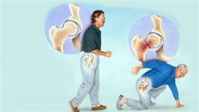 «اكتشفيها مبكرًا».. ما هي أعراض هشاشة العظام؟