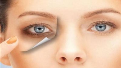 طريقة علاج الهالات السوداء تحت العين