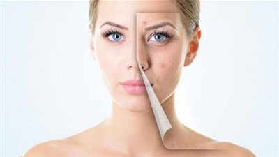 أسباب ظهور حب الشباب للفتيات