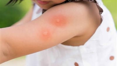 ما هو الطفح الجلدي وطرق علاجه؟