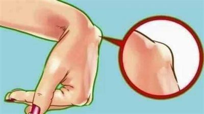 علاج الكيس الدهني في المعصم أو الرقبة