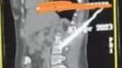 طوارئ قصر العينى تجري جراحة خطرة لاستخراج سكين من ظهر سيدة