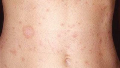 أسباب وأعراض النخالة الوردية