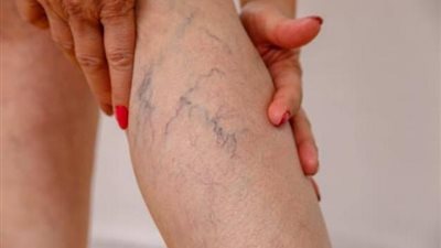 باجراءات بسيطة.. علاج دوالي الساقين