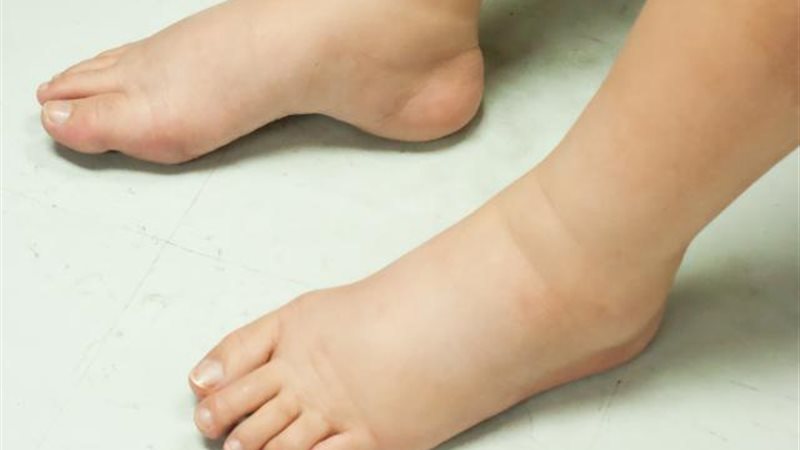 مشكلة احتباس الماء