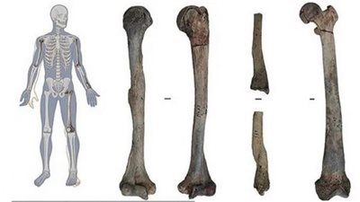 عصور ما قبل التاريخ.. العثور على أقدم حالة هشاشة عظام عمرها 6600 ألف عام فما قصتها؟