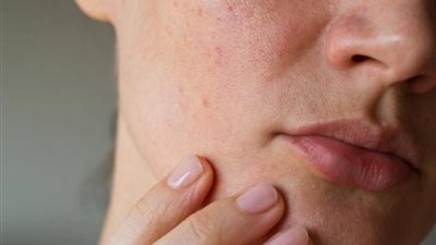 لبشرة نضرة.. حيل سحرية  لعلاج المسام الواسعة في المنزل