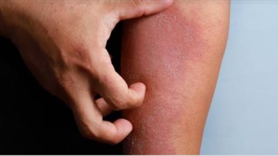 روشتة علاجية سريعة لمحاربة الحساسية في لمح البصر.. فما هي؟