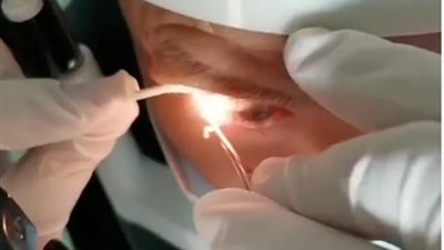 حالة غريبة من نوعها.. تفاصيل استخراج 20 دودة حية من عين رجل عاشت بداخله لمدة عام