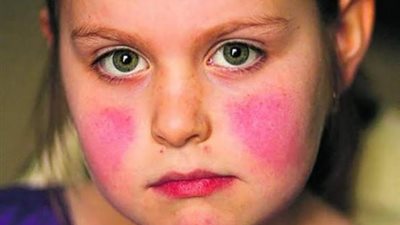 أسباب وأعراض مرض الذئبة الحمراء