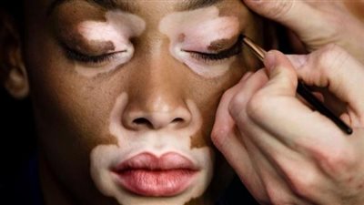 منتشر ويظهر فجأة.. أعراض مرض البهاق