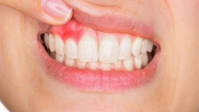 السبب الرئيسي لتدهور حالات الزهايمر.. ما لا تعرفه عن أمراض اللثة