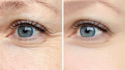 حيل سحرية للتخلص من التجاعيد تحت العين.. تعرفي عليها