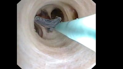 بالفييو.. ديدان غريبة في بطن مريض تفاجئ الأطباء أثناء عملية جراحية